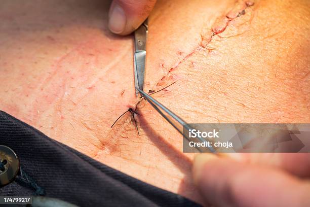 Nurse At Workremoving Stitches From A Wound Stock Photo - Download Image Now - A Helping Hand, Assistance, First Aid