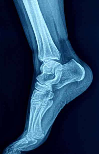 imagerie par rayons x des pieds - bending human foot ankle x ray image photos et images de collection