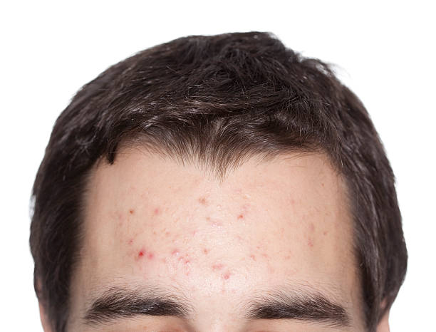 acne. - wound sunburned scar physical injury foto e immagini stock