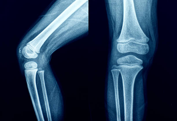 raio-x esqueleto humano joelho da perna anatomia - bending human foot ankle x ray image - fotografias e filmes do acervo