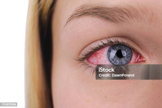 Red Sore Eye Stock Photo - Download Image Now - Sore Eyes, Close-up, Blue