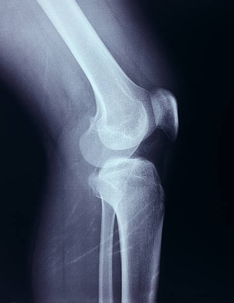 raio-x esqueleto humano joelho da perna anatomia - bending human foot ankle x ray image - fotografias e filmes do acervo