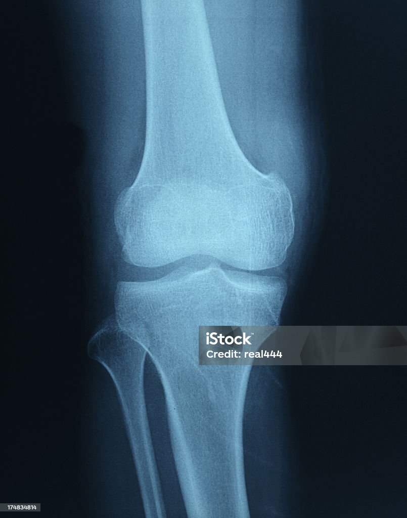 Колено рентгенографии костей Нога человека Анатомия - Стоковые фото Medial Meniscus роялти-фри