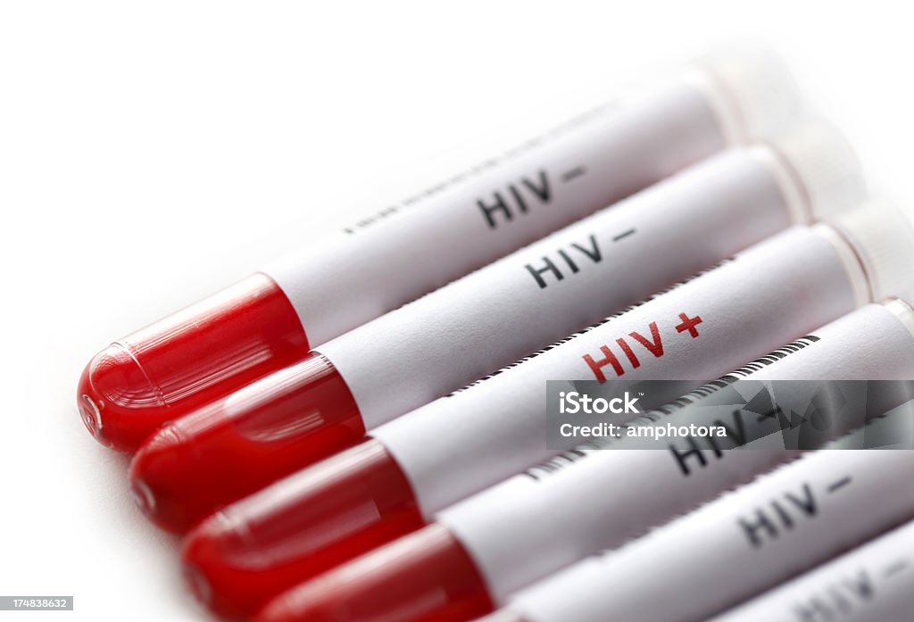 HIV テスト - ヒト免疫不全ウィルスのロイヤリティフリーストックフォト