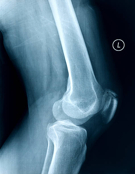 膝の部位の x 線骨人の脚 - cartilage patella human knee medical exam ストックフォトと画像