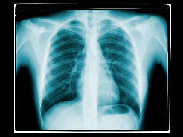 istock X-ray Of Ribcage 174844940