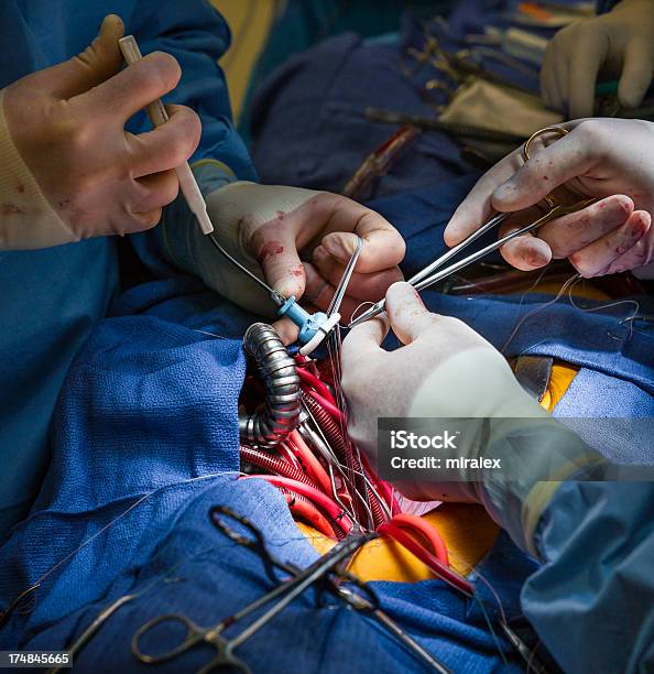 Foto de Cirurgia Cardíaca Válvula Mitral Reposição Com Mecânico Substituto e mais fotos de stock de Válvula mitral