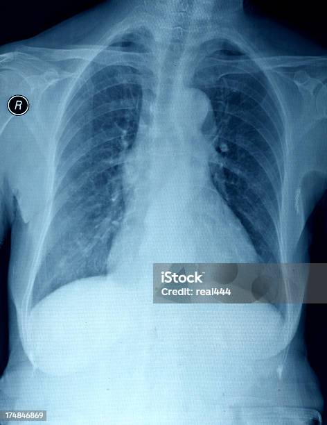 흉부 X선 이미지 X-레이에 대한 스톡 사진 및 기타 이미지 - X-레이, 갈비사이공간, 건강 진단