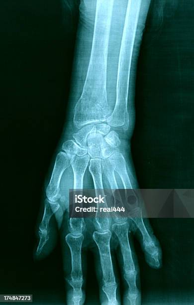 손으로 X선 X-레이에 대한 스톡 사진 및 기타 이미지 - X-레이, 건강 검진 결과, 건강 진단