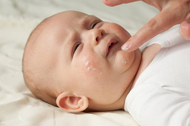 istock Baby with atopic dermatitis getting cream put on 174852420