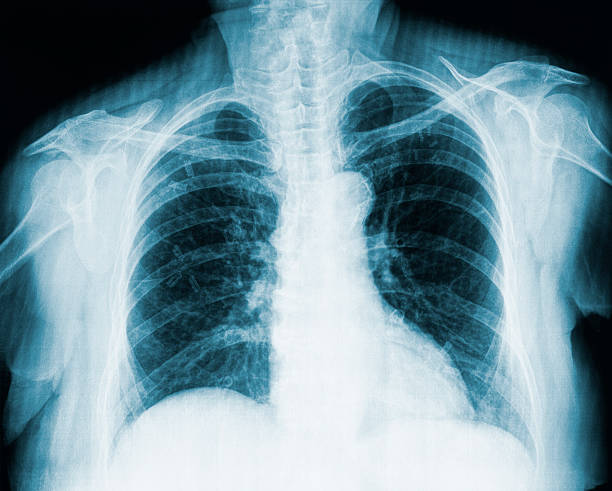 istock X-ray Of Ribcage 174852565
