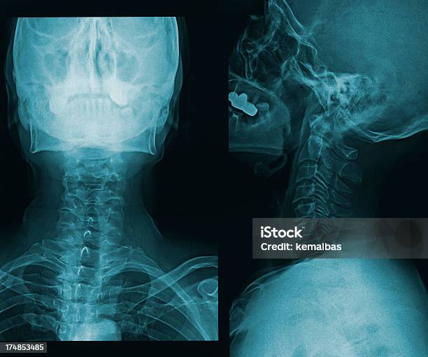 Xray Z Mózgu W Czaszki - zdjęcia stockowe i więcej obrazów Anatomia człowieka - Anatomia człowieka, Badanie lekarskie, Ciało ludzkie