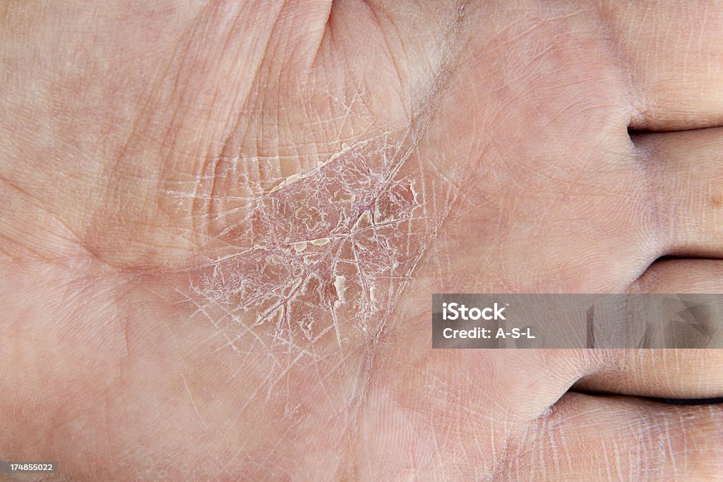 Homme avec l'eczéma palm - Photo de Peau libre de droits