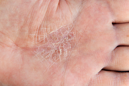 Eczema skin on male palm