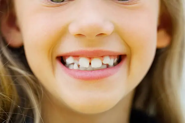 Close up of a child's mouth. Crooked teeth present.