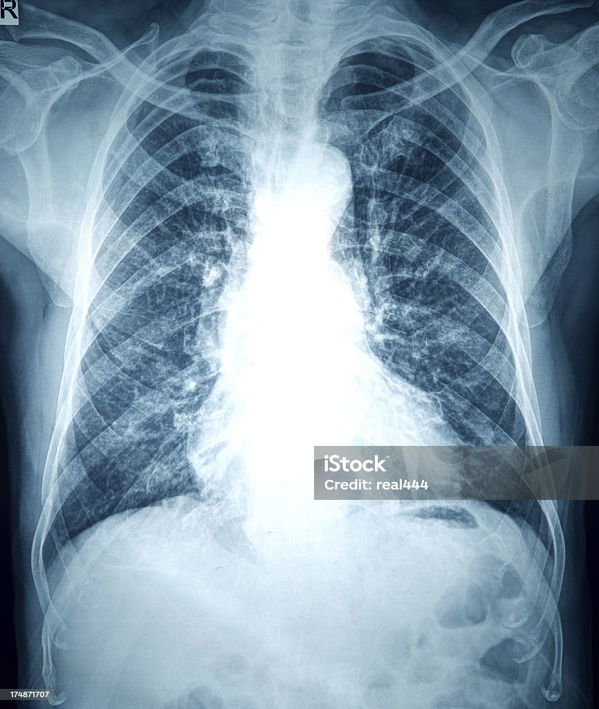 Una radiografía de tórax imagen - Foto de stock de Anatomía libre de derechos