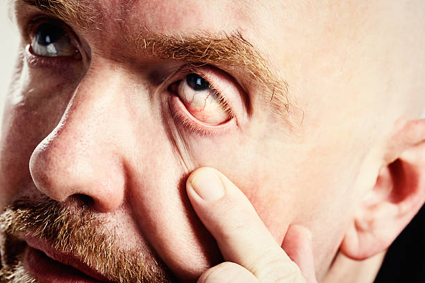 Unhappy man shows his bloodshot eye: hangover or conjunctivitis? "Close up of balding, bearded mature man pulling down his eyelid to reveal a very bloodshot eye. Hungover Probably, but also possibly a case of pink eye." drunk visual stock pictures, royalty-free photos & images