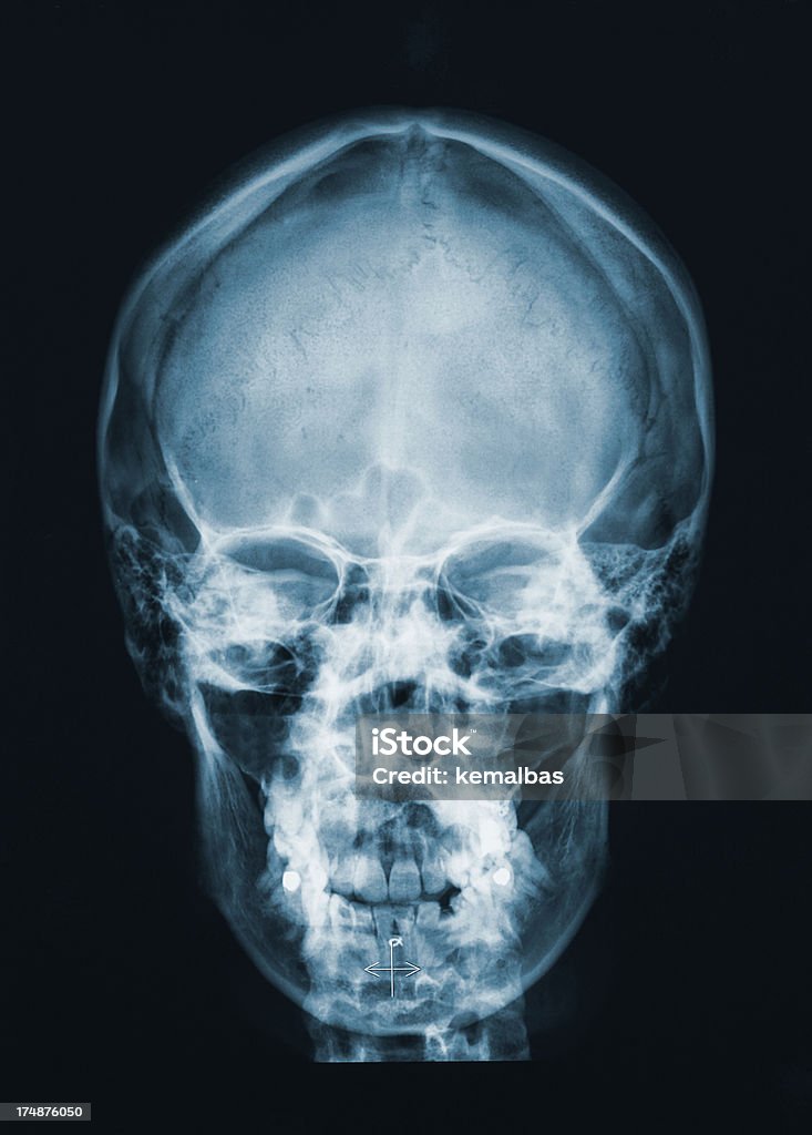 X-레이 뇌 In 스컬 - 로열티 프리 MRI 스캔 스톡 사진