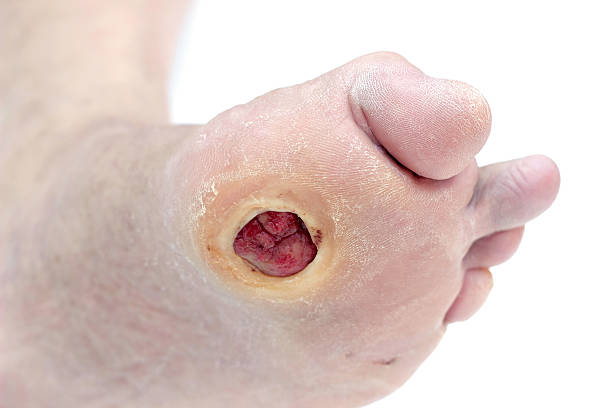 piede diabetico ulcera - human foot diabetes ulcer senior adult foto e immagini stock