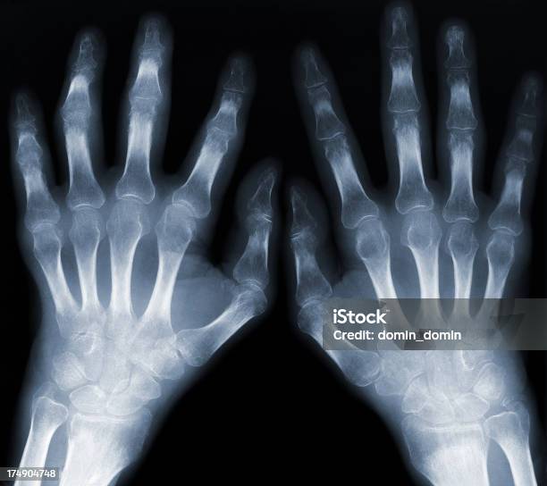 Две Руки Клетки — стоковые фотографии и другие картинки Запястье - Запястье, Рентгеновский снимок, Болезнь