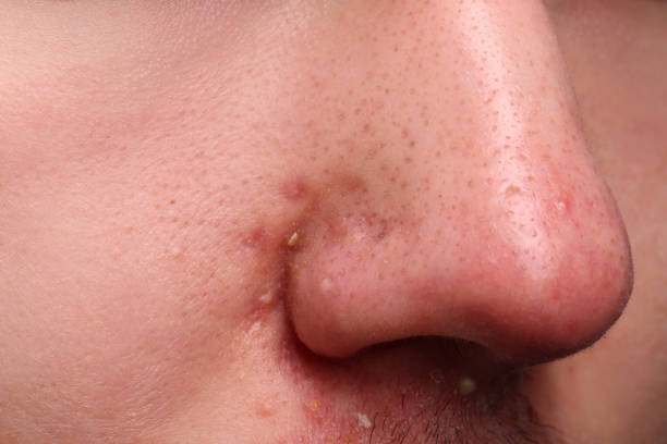 istock Young man with acne problem, closeup view of nose 1749103941