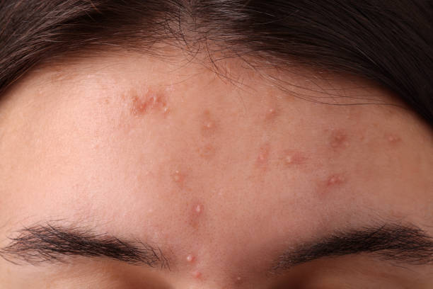 istock Young woman with acne problem, closeup view 1749103947