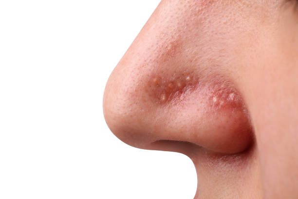 istock Young woman with acne problem on grey background, closeup 1749103980