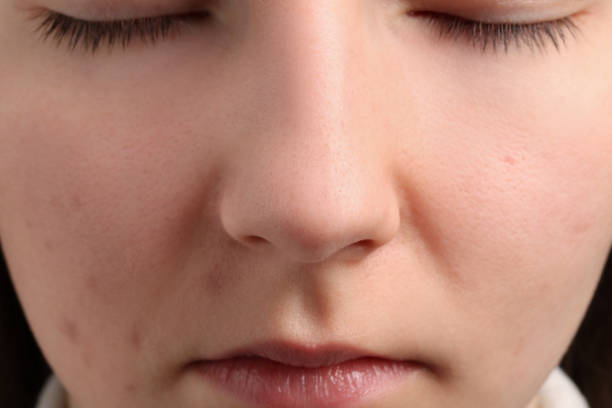istock Young woman with acne problem, closeup view 1749103989