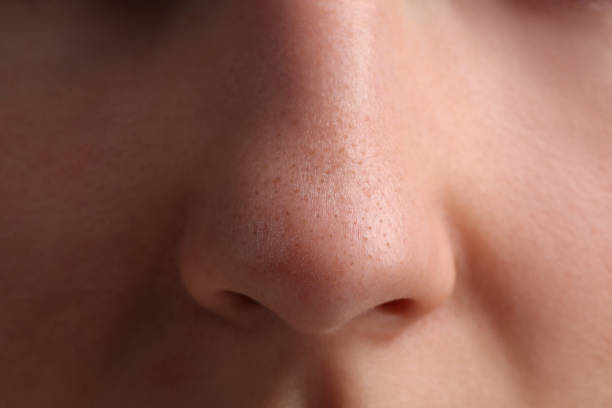 istock Young woman with acne problem, closeup view of nose 1749104518