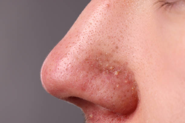 istock Young man with acne problem on grey background, closeup view of nose 1749104560