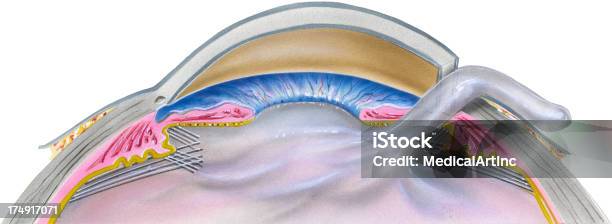 Vetores de Eyecataract Cirurgia Etapa 2 e mais imagens de Anatomia - Anatomia, Catarata, Cirurgia