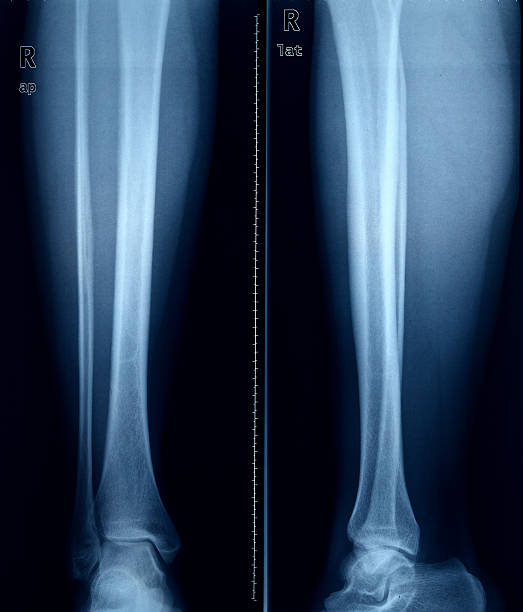 imagerie par rayons x des pieds. - bending human foot ankle x ray image photos et images de collection