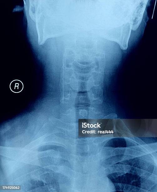 X선 영상 X-레이에 대한 스톡 사진 및 기타 이미지 - X-레이, 건강 진단, 건강관리와 의술