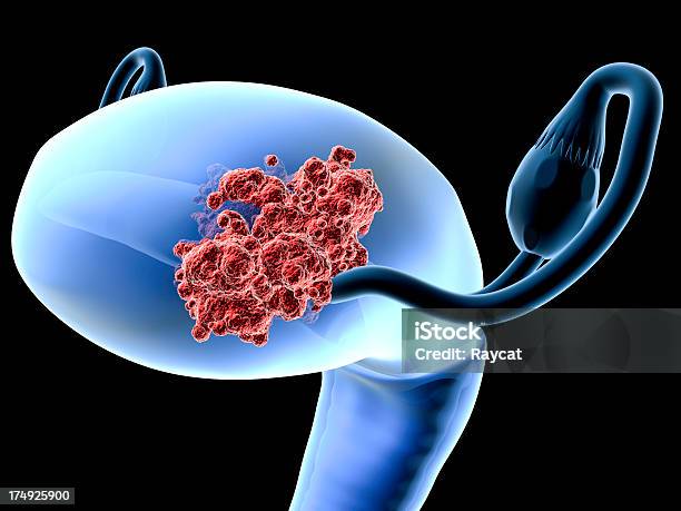 Photo libre de droit de Endometrial Le Cancer banque d'images et plus d'images libres de droit de Cancer - Cancer, Cellule cancéreuse, Endomètre