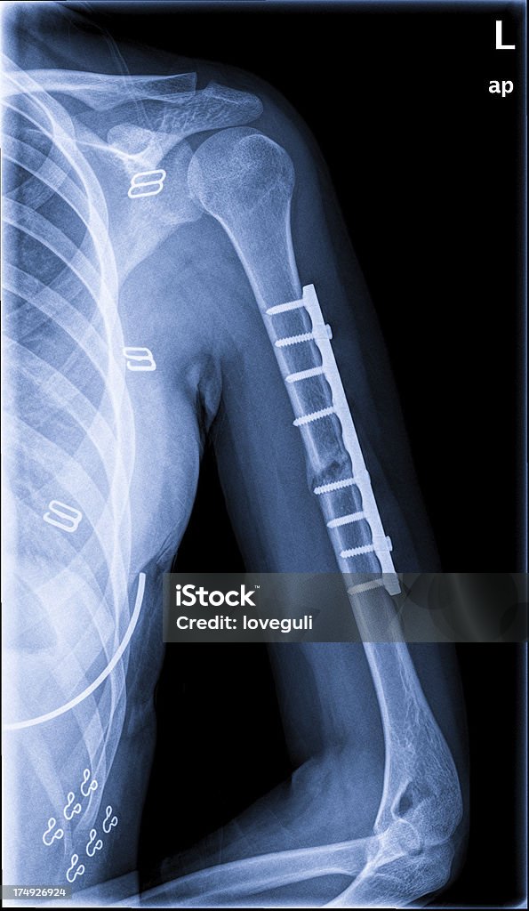 Рука Перелом x ray - Стоковые фото Рентгеновский снимок роялти-фри