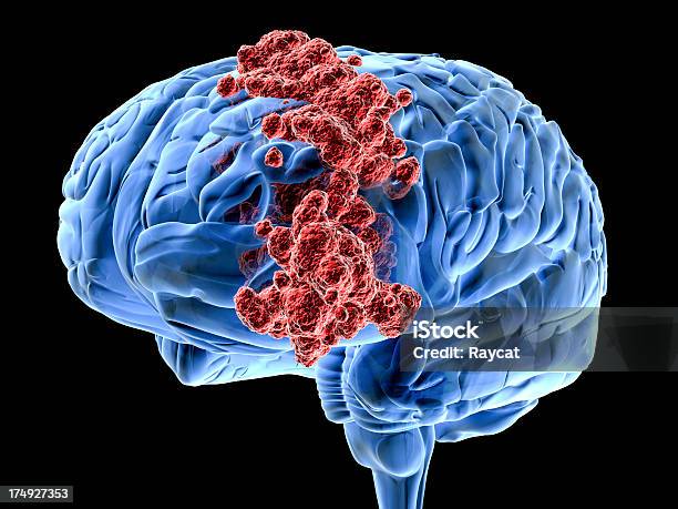 뇌 게자리 종양에 대한 스톡 사진 및 기타 이미지 - 종양, 뇌종양, 지력
