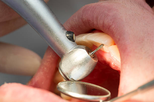 istock Macro of dental drill 174930792