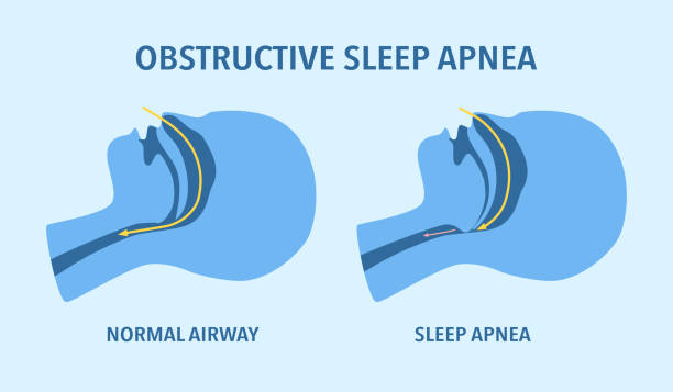 ilustraciones, imágenes clip art, dibujos animados e iconos de stock de concepto de apnea obstructiva del sueño. trastorno del sueño. - apnea del sueño