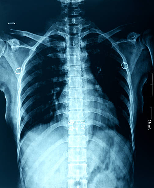 胸 x 線画像 - pain rib cage x ray image chest ストックフォトと画像