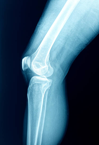 imagem de raios x do pé - bending human foot ankle x ray image - fotografias e filmes do acervo