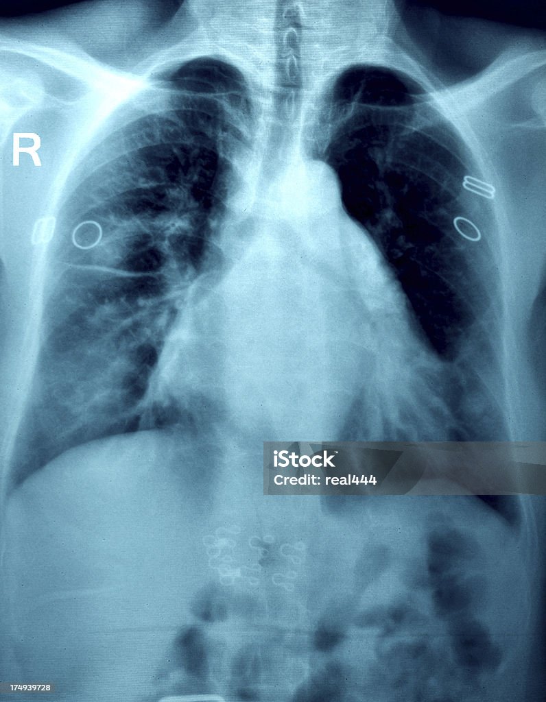 Chest X-ray image Anatomy Stock Photo