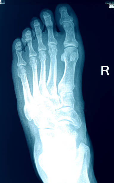 imagerie par rayons x des pieds - bending human foot ankle x ray image photos et images de collection