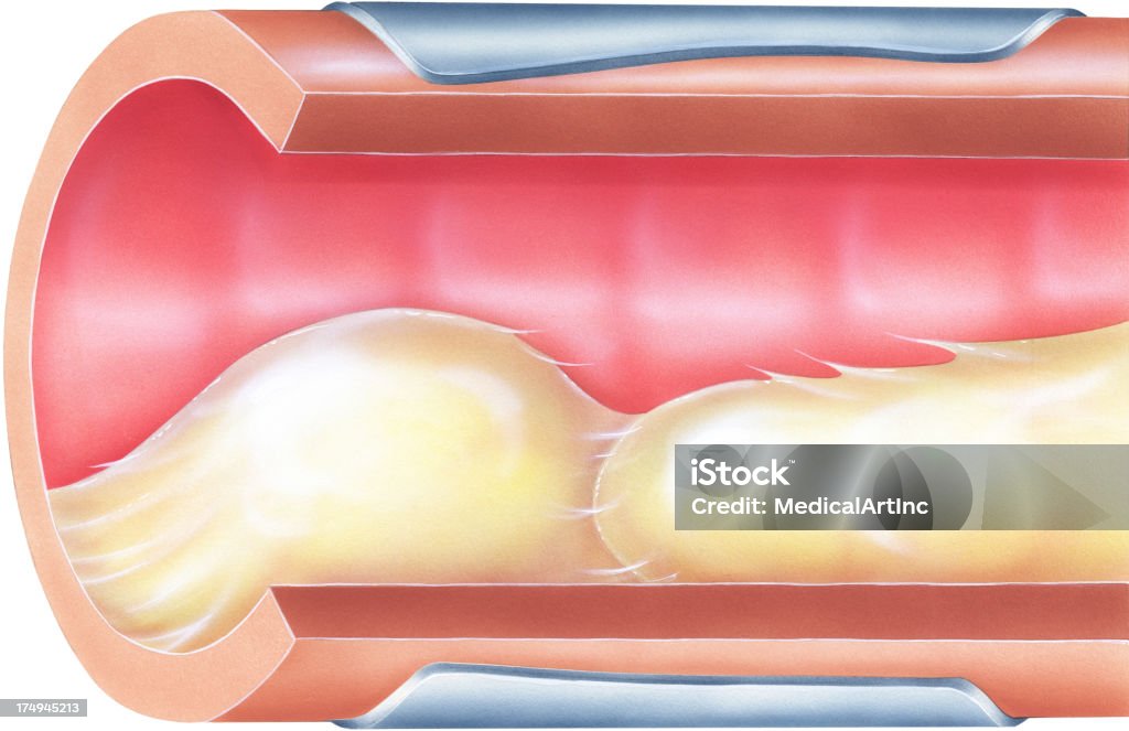 Bronchit Lungs Bronchial Mucus Causing Airway Obstruction Stock Illustration ...