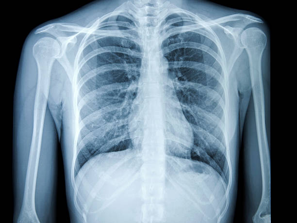 chest X-ray image chest X-ray image showing lungs, heart, rib cage, and clavicle x ray image stock pictures, royalty-free photos & images
