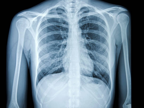 zdjęcie rentgenowskie klatki piersiowej - rib cage people x ray image x ray zdjęcia i obrazy z banku zdjęć