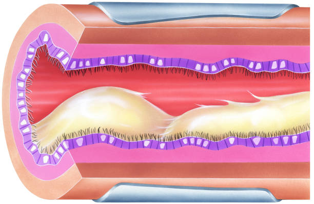 ilustraciones, imágenes clip art, dibujos animados e iconos de stock de pulmones bronquial mucosidad causa de obstrucción de las vías aéreas & estrechamiento - mucosidad