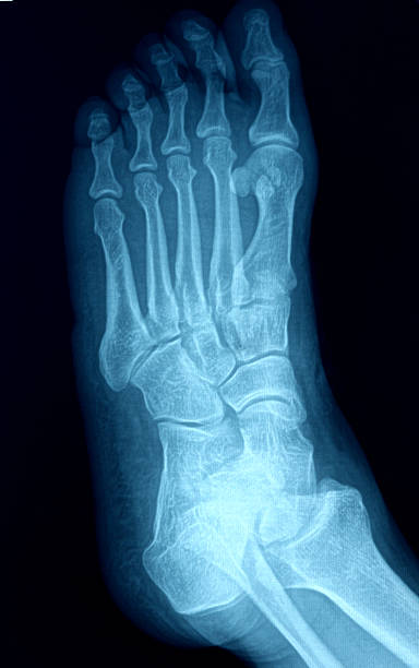 imagem de raios x do pé - bending human foot ankle x ray image - fotografias e filmes do acervo