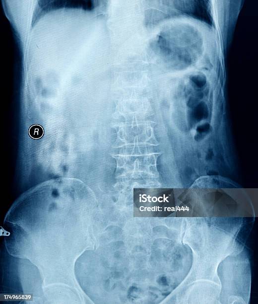 Foto de Xray e mais fotos de stock de Abdome - Abdome, Abdômen Humano, Anatomia