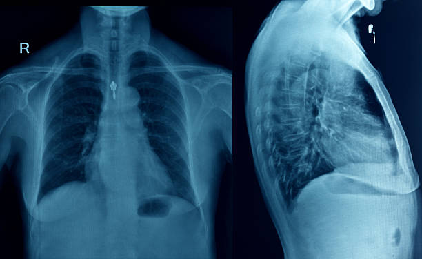 胸 x 線画像 - pain rib cage x ray image chest ストックフォトと画像