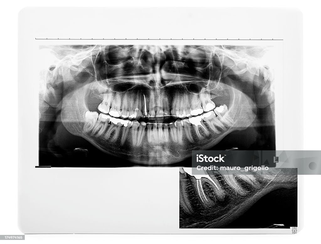 Zahn x-ray - Lizenzfrei Anatomie Stock-Foto